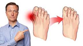 How to Fix Bunions in 3 Steps