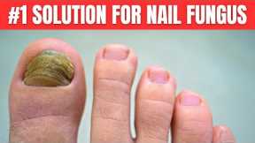 You Need Only 2 Ingredients To Get Rid of Nail Fungus Completely