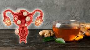 How to Treat Uterine Fibroids Naturally