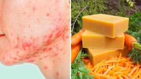 DIY Carrot Soap To Heal Acne, Treat Pimples, Ligthen Skin and More