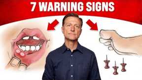 The 7 WARNING Signs of a B12 Deficiency - Dr. Berg