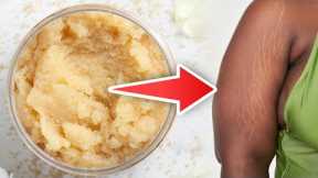 How To Get Rid of Stretch Marks Naturally