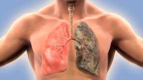 How to Get Back Healthy Lungs After Smoking