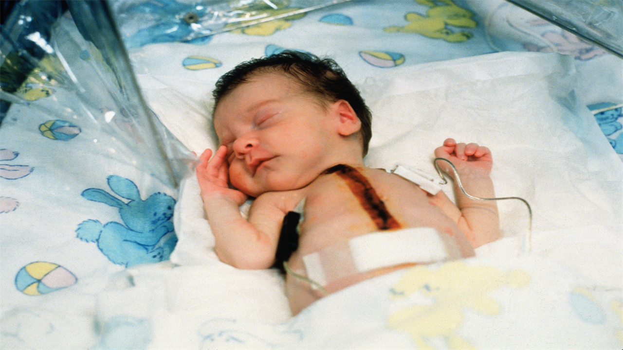 Baby Fae After Heart Transplant