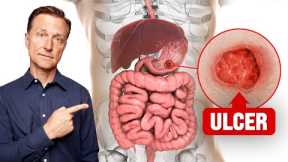 The FASTEST Way to Heal an Ulcer