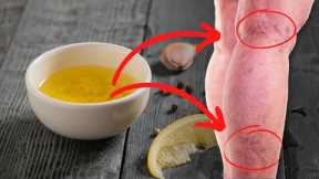 Mix Olive Oil and Garlic and Say Goodbye To Varicose Veins