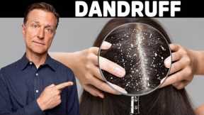 The REAL Cause and Cure for DANDRUFF