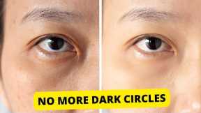 How to Get Rid Of Dark Circles Under The Eyes Fast and Naturally