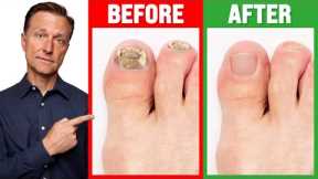 The REAL Cause of and CURE for Toenail Fungus