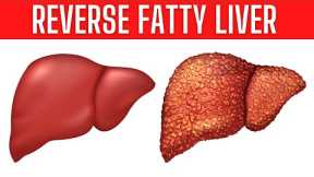 These Home Remedies Can Reverse Fatty Liver Naturally