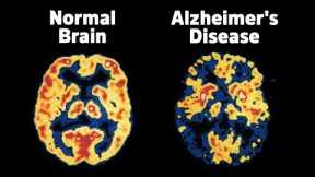 Groundbreaking New Revelations on Alzheimer's Disease