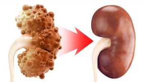 The REAL Cause of Chronic Kidney Disease and Polycystic Kidney Disease