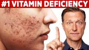 The Top Vitamin Deficiency with Acne