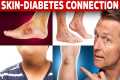 9 Diabetic Skin Problems That