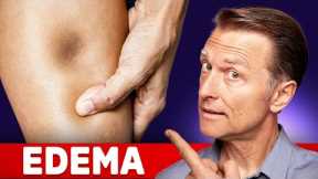 The 8 Causes of Edema