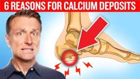 6 Reasons for Calcium Deposits (Spurs, Osteophytes, Stones, and Tartar)