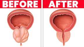 Drink 1 CUP PER DAY to Shrink an Enlarged Prostate