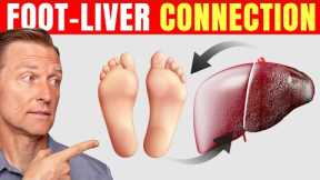 How to Use Your Feet to Diagnose Liver Problems—Dr. Berg Explains
