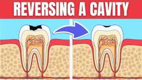 How To Reverse a Cavity Naturally at Home (Cure Tooth Decay)