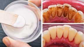 #1 Home Remedy to Remove Plaque, Tartar and Prevent Cavities