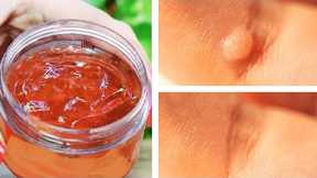 Rub This on Your Wart To Kill the Virus and Remove It Forever