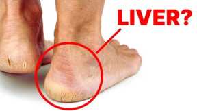 Is Your Liver Crying for Help? Check Your Feet for These Alarming Signs!