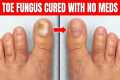 Toe Nail Fungus Cured With No Meds!
