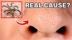 This is the Real Cause of Your Blackheads (and How to Get Rid of Them for Good!)