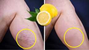 Lemon Removes Varicose Veins! Just Do This Every Day...